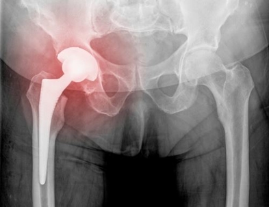 Injured Hip